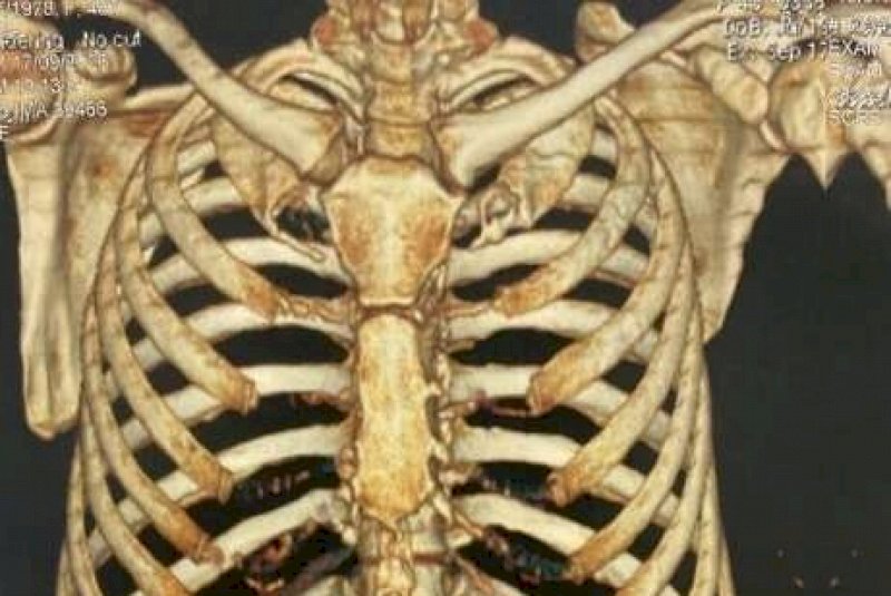 Mulher com 4 costelas quebradas &eacute; liberada de UPA ap&oacute;s acidente de moto