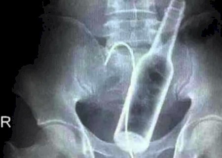 Jovem enfia garrafa no ânus durante bebedeira e vai parar no hospital