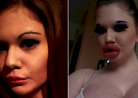 Modelo com os maiores lábios do mundo planeja aumentá-los ainda mais, apesar de 'risco fatal'