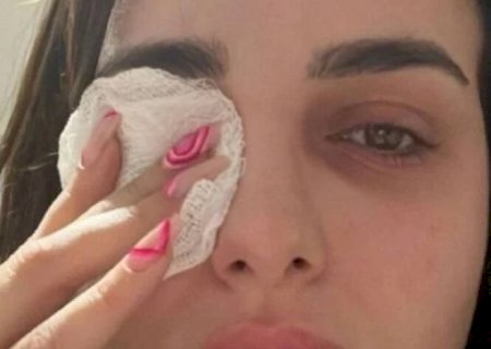 Influenciadora arranca pedaço da córnea ao coçar olho