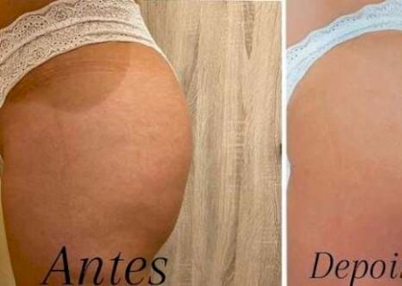 Bumbum empinado e sem celulite &eacute; com a Royal Face
