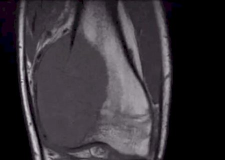 Com tumor raro, universit&aacute;rio faz vaquinha para conseguir R$ 170 mil