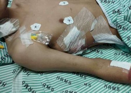 Jovem perde parte do pulm&atilde;o por usar vape e narguile