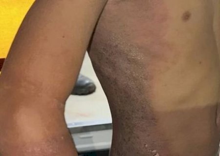 Maracaju: Pipa encosta em fio de alta tens&atilde;o e adolescente tem queimaduras de 2º grau