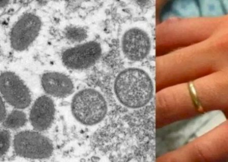 Corumbá: Secretaria de Saúde confirma caso de Mpox em homem de 27 anos