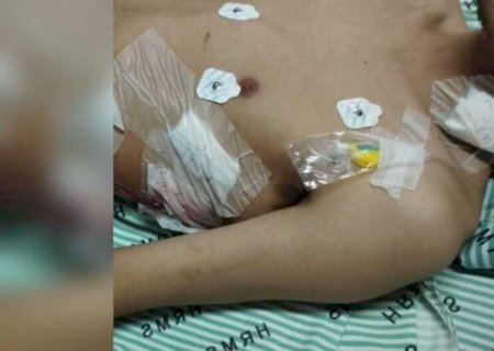 Jovem que perdeu pulmão se arrepende do uso de 'pod' e tenta recomeçar vida: 'está congregando'