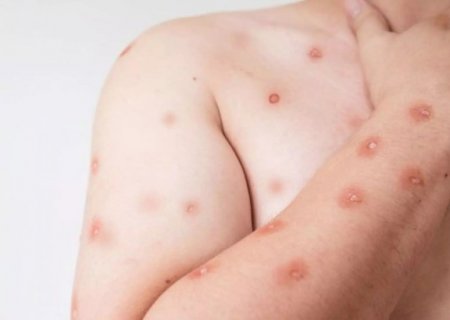 Campo Grande tem 7 casos confirmados de MPox e 2 em investiga&ccedil;&atilde;o