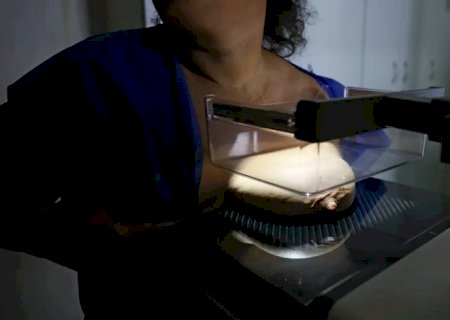 ANS defende que plano cubra mamografia digital sem restrição de idade