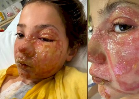 Menina sofre queimaduras no rosto após reproduzir desafio viral de rede social