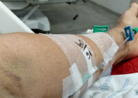 Diabética quebra perna em dois pontos e aguarda cirurgia sem previsão na Santa Casa