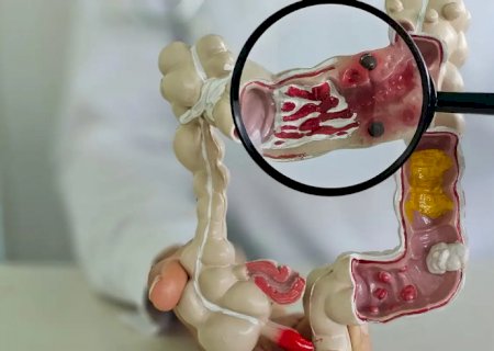 Em 13 anos, doença inflamatória intestinal cresce 5 vezes no Brasil