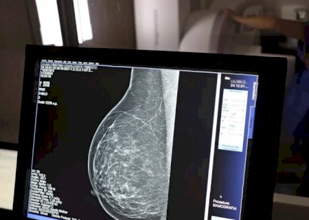 Médicos lançam guia para evitar recusa de mamografia digital